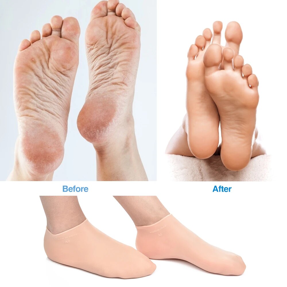 SoftFeet | Plus jamais de pieds douloureux (1 PAIRE)